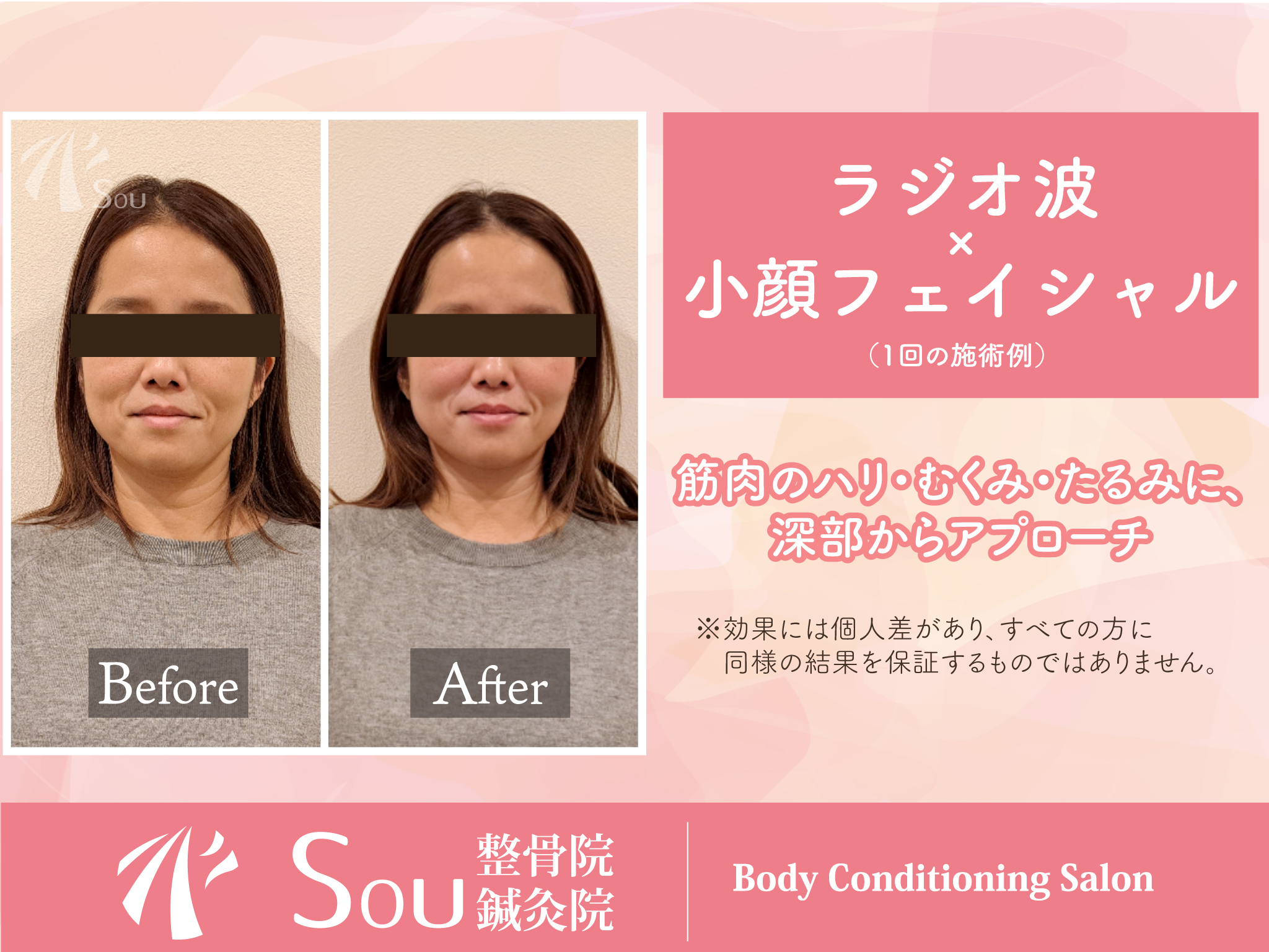 ラジオ波フェイシャルビフォーアフターの画像