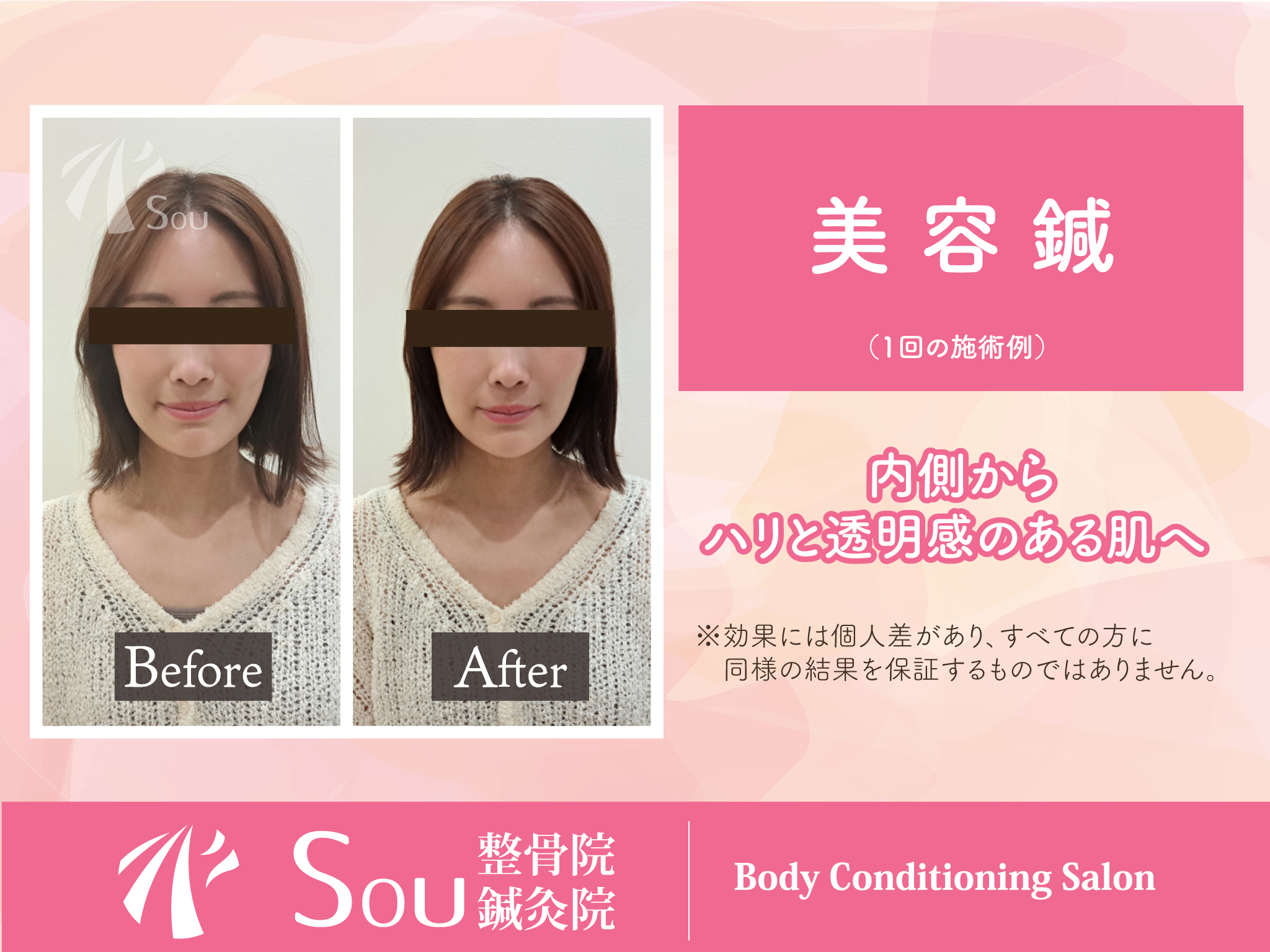 Souの美容鍼の画像